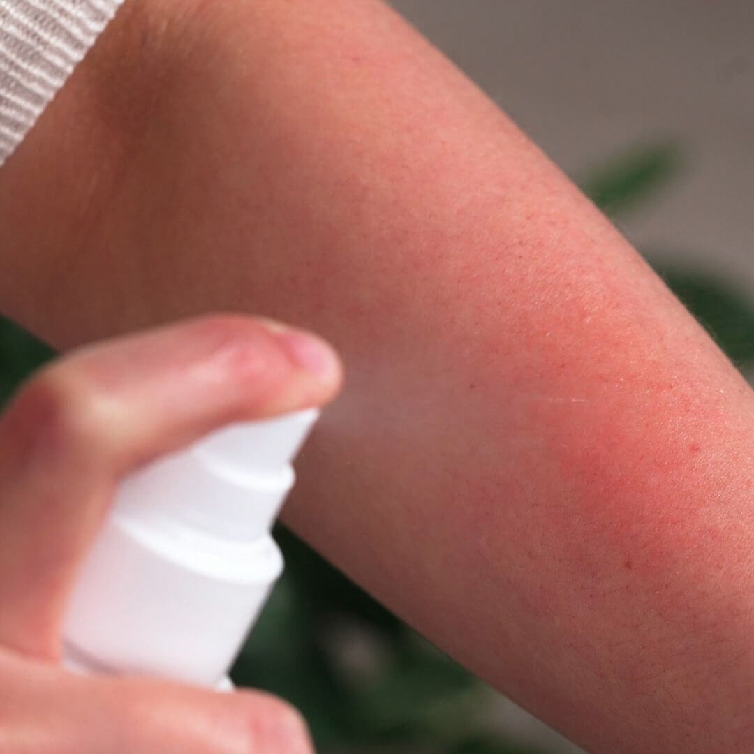 Spray för att lindra klåda på kroppen - Lugnande och lindrande klådstillande spray för irriterad hud