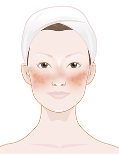 Rosacea – Så behandlar och förebygger du