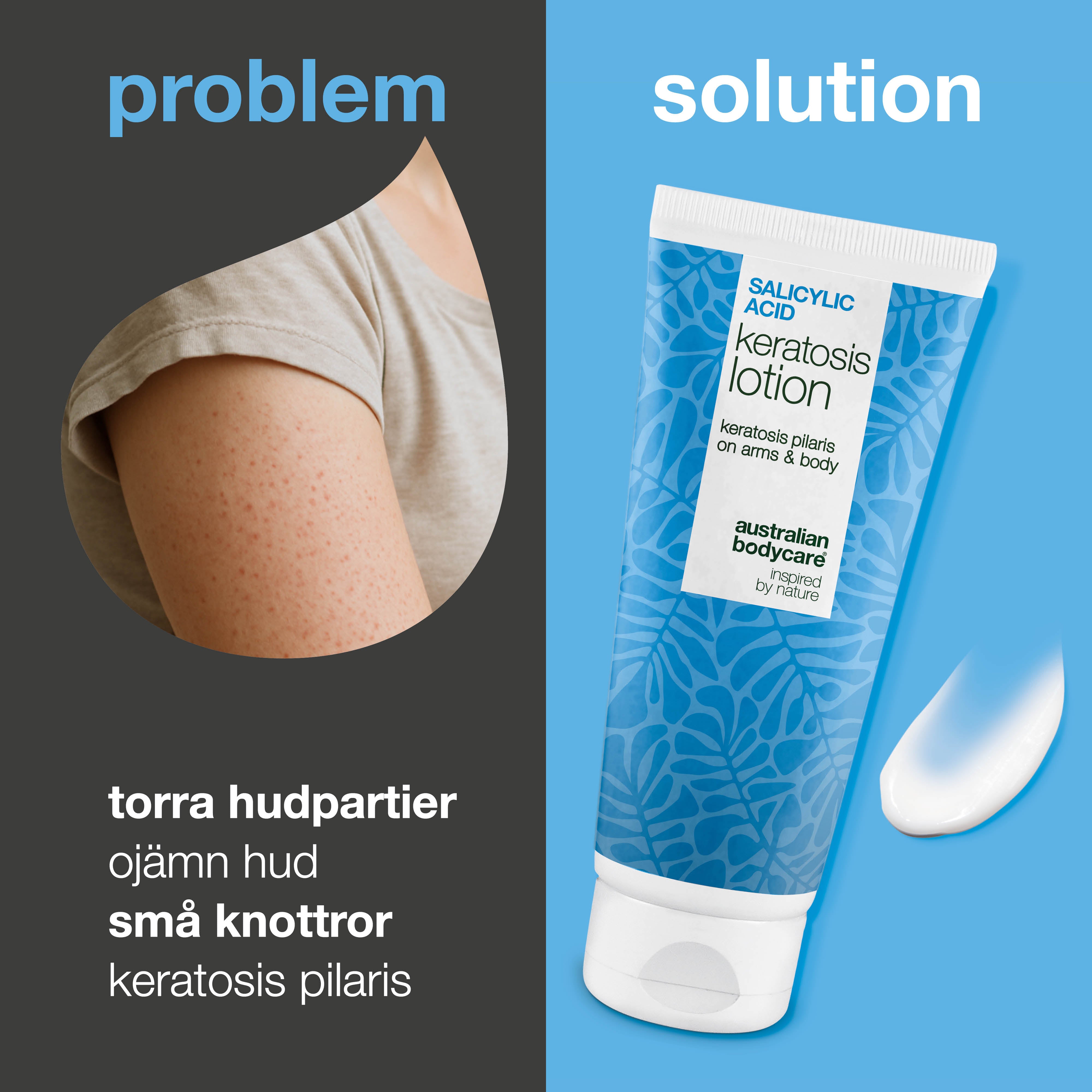 Body lotion mot keratosis pilaris och torr, knottrig hud — Body lotion mot keratosis pilaris. Jämnar ut med salicylsyra, niacinamid och zink. Perfekt för torr och ojämn hud.