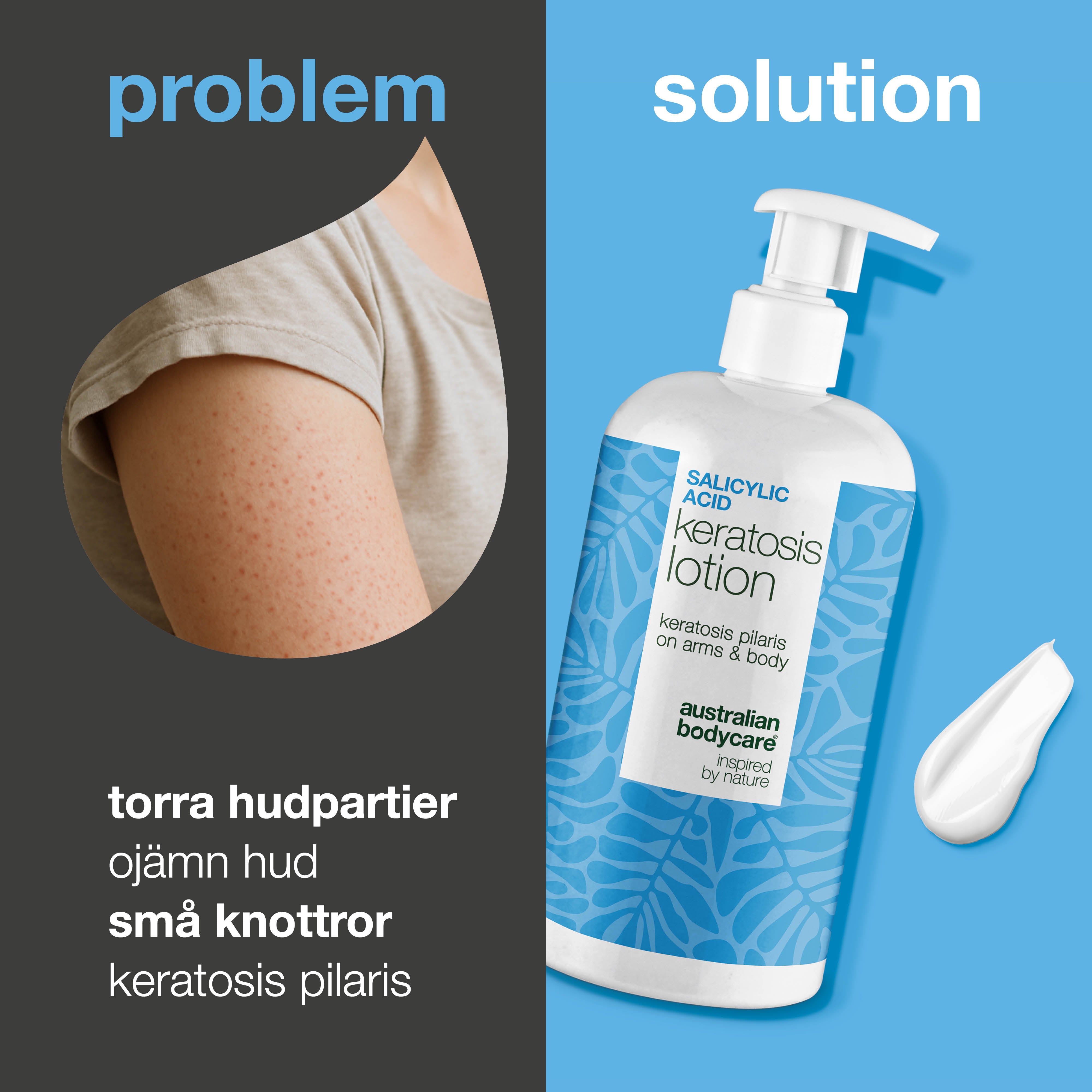 Body lotion mot keratosis pilaris och torr, knottrig hud — Body lotion mot keratosis pilaris. Jämnar ut med salicylsyra, niacinamid och zink. Perfekt för torr och ojämn hud.