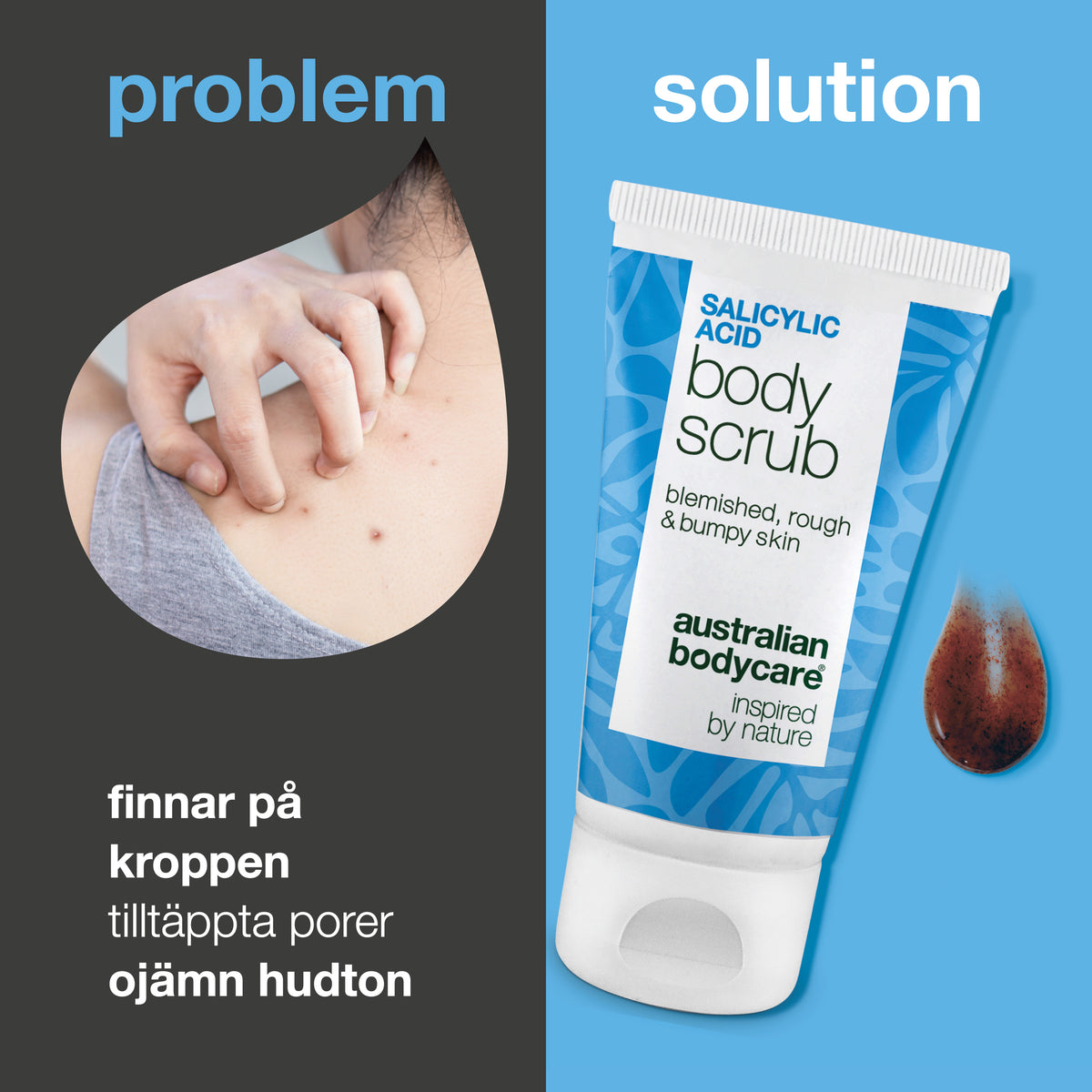 Problem och lösning: finnar på kroppen, tilltäppta porer och ojämn hud. Till vänster en närbild av en axel med finnar, till höger Salicylic Acid Body Scrub från Australian Bodycare