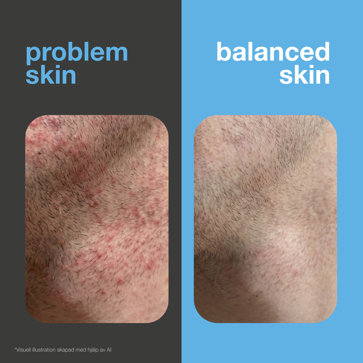 Före och efter: rakad hud med rakknottror och irritation mot slät och lugnad hud. Visuell illustration.
