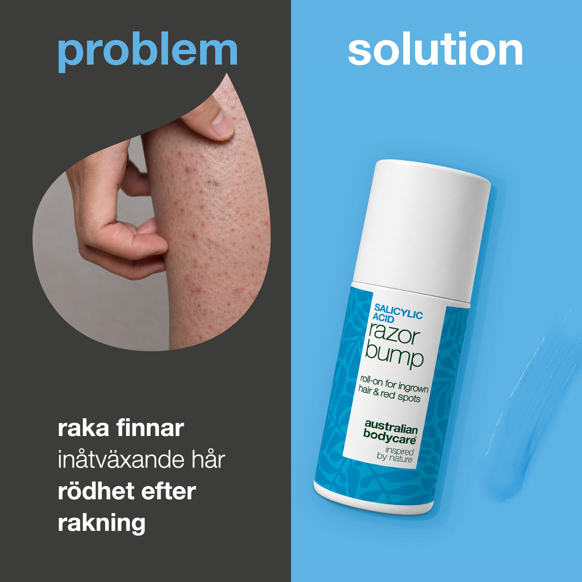 Problem och lösning: rakfinnar, inåtväxande hår och rodnad efter rakning. Till vänster en närbild av en hand som nyper i ett lår med röda finnar, till höger en Salicylsyra Razor Bump roll-on från Australian Bodycare.