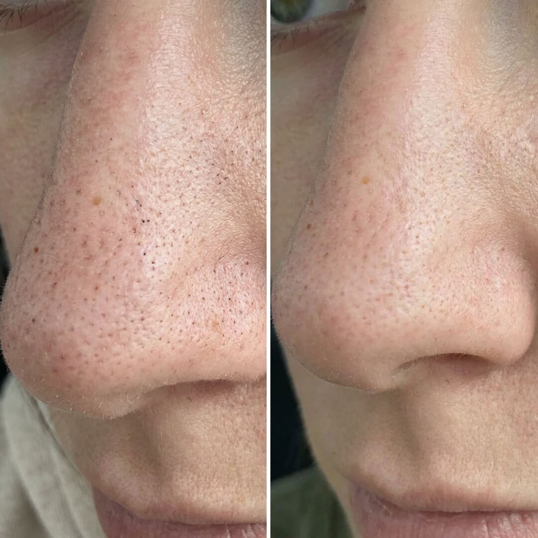 Paket mot pormaskar och tilltäppta porer med salicylsyra – djuprengörande rutin för slät hud