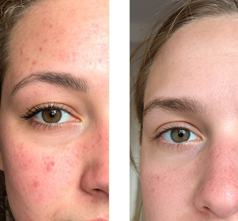 Före- och efterbild på en kund som använder vår 2% Salicylic Acid Face Toner/Peeling/Exfoliant, vilket visar stor förbättring av huden med färre finnar och orenheter.