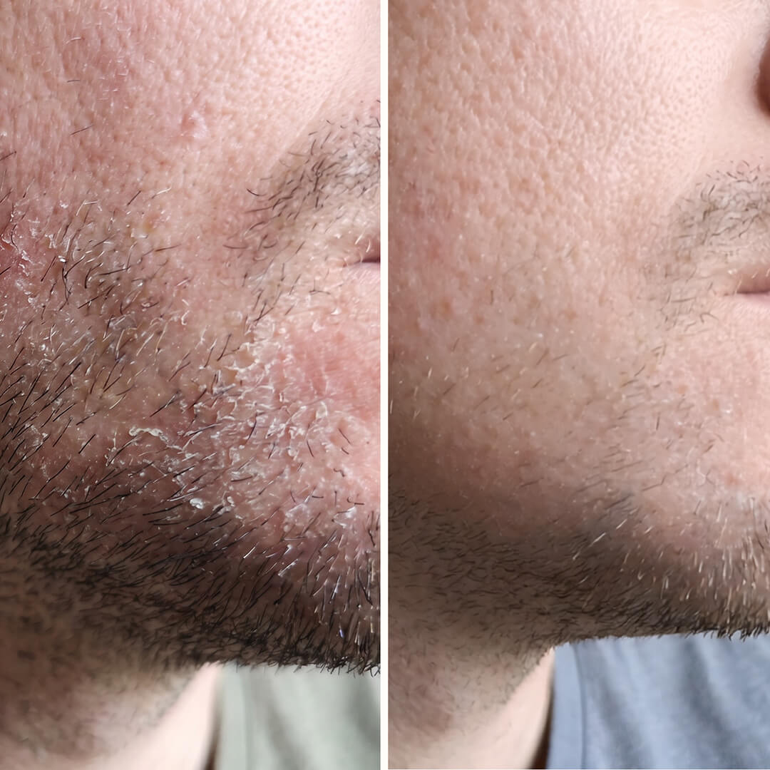 Salicylsyra Serum – Mot mjäll i ansiktet, skägg och bryn — Effektivt serum mot mjäll i ansiktet och skägget. Salicylsyra tar bort flagor och rodnad snabbt så att huden återfår sin sunda balans.