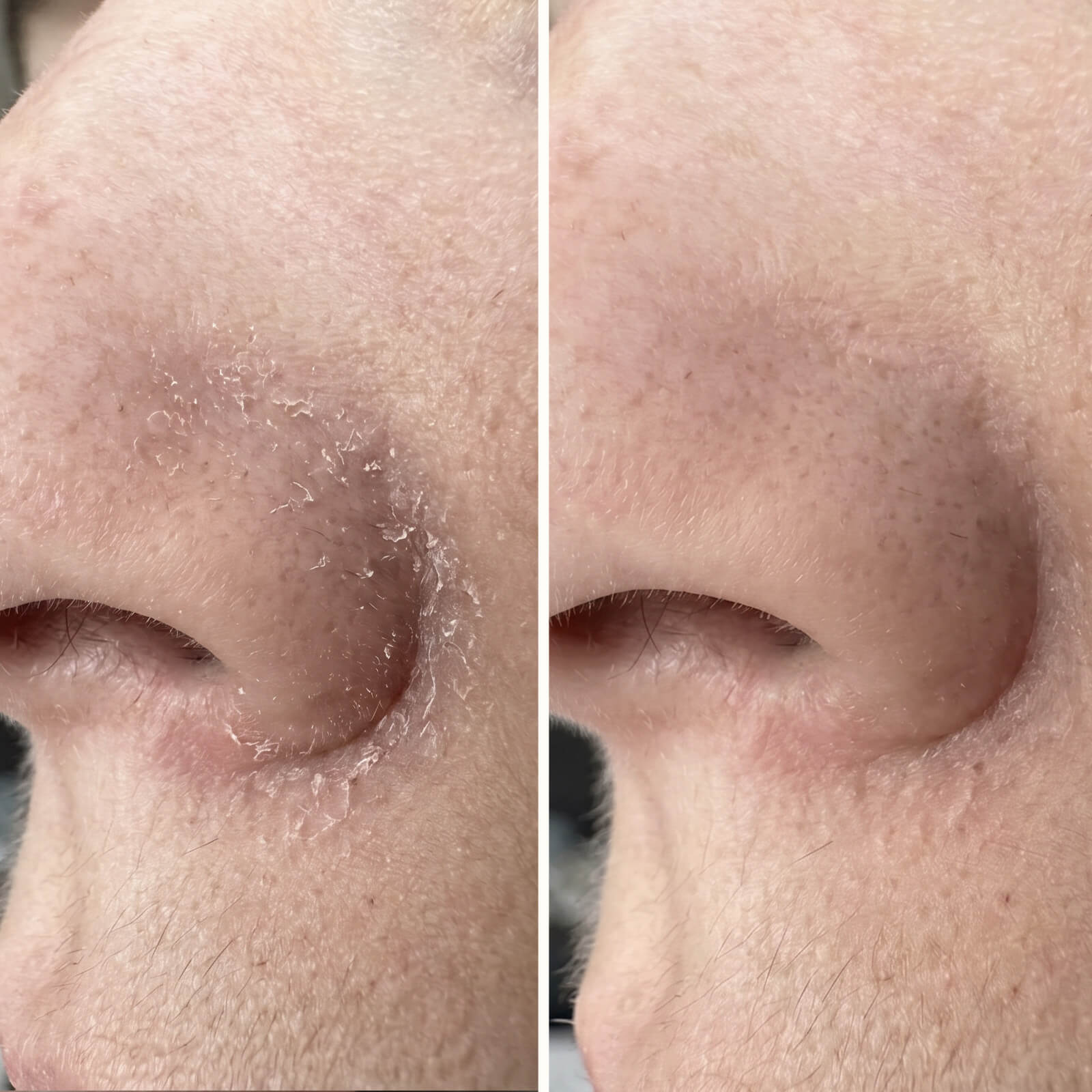 Salicylsyra Serum – Mot mjäll i ansiktet, skägg och bryn — Effektivt serum mot mjäll i ansiktet och skägget. Salicylsyra tar bort flagor och rodnad snabbt så att huden återfår sin sunda balans.
