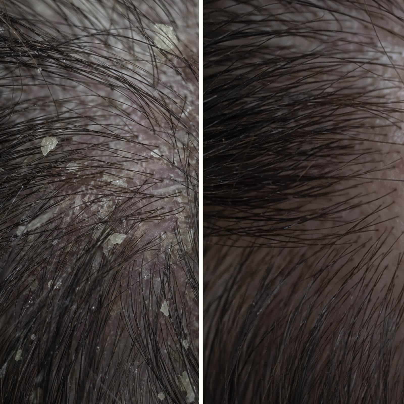Salicylsyra hårbottenkur mot mjäll, klåda och olja — Salicylsyra hårbotten serum lindrar klåda, mjäll och fett. Använd före tvätt för djup exfoliering med aktiv salicylsyra.