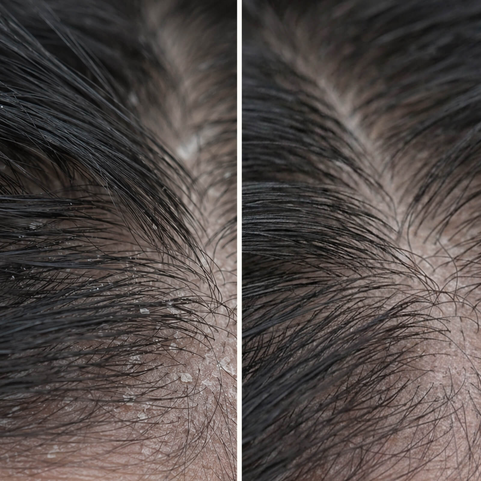 Salicylsyra hårbottenkur mot mjäll, klåda och olja — Salicylsyra hårbotten serum lindrar klåda, mjäll och fett. Använd före tvätt för djup exfoliering med aktiv salicylsyra.