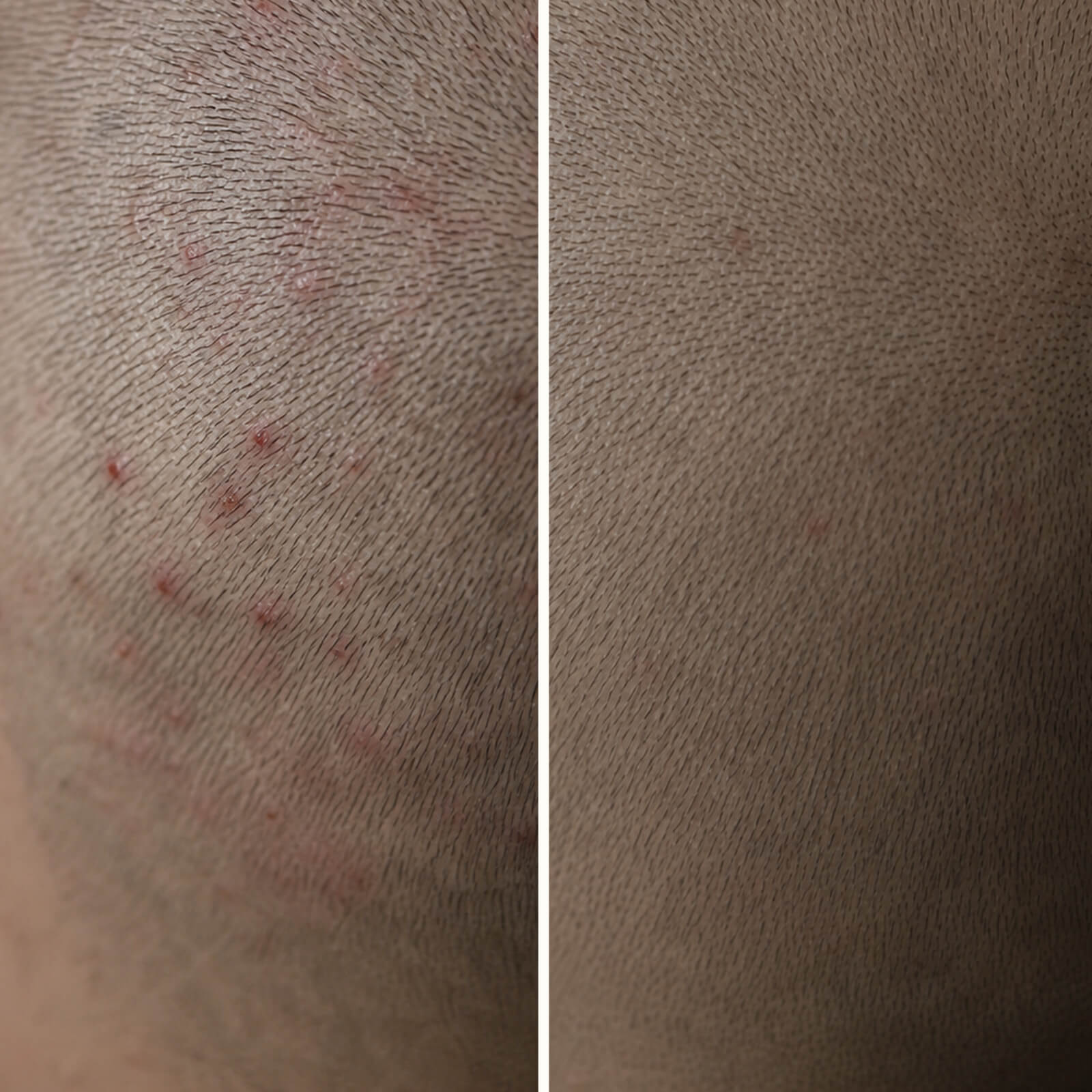 Salicylsyra Gel mot finnar och klåda i hårbotten — Stoppa finnar i hårbotten med Salicylsyra. Gelen exfolierar porer, minskar olja och lugnar rodnad och klåda effektivt och naturligt.