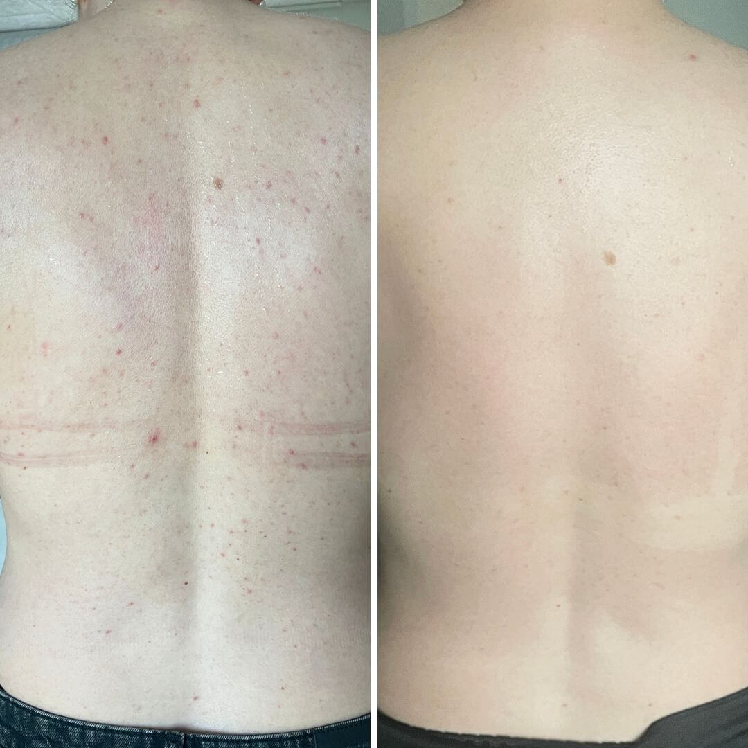 Före- och efterbild av en rygg med synliga finnar och akne på "före"-bilden, och en klar, slät rygg utan blemmor efter 4 veckors regelbunden användning av Australian Bodycare Salicylsyra Body Spray.