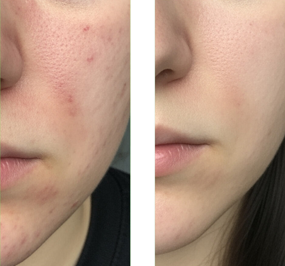 Före- och efterbild på en kund som använder vår Salicylic Acid Cleanser, vilket visar stor förbättring av huden med färre finnar och orenheter.