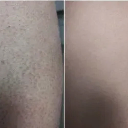 Alenas resultat efter 2 veckor med keratosis pilaris-paketet