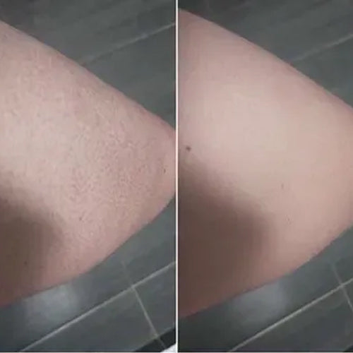 Keratosis pilaris före och efter – Alenas slätare hud efter 2 veckor
