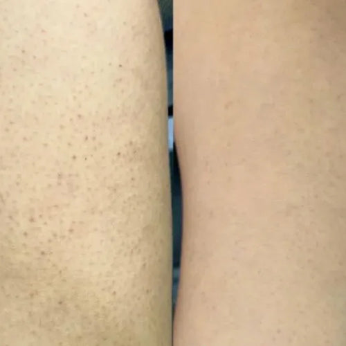 Isabells resultat med keratosis pilaris-paketet – färre knottror på låren