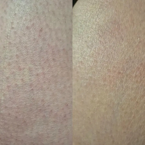 Närbild av hud efter keratosis pilaris-behandling – Carolins resultat