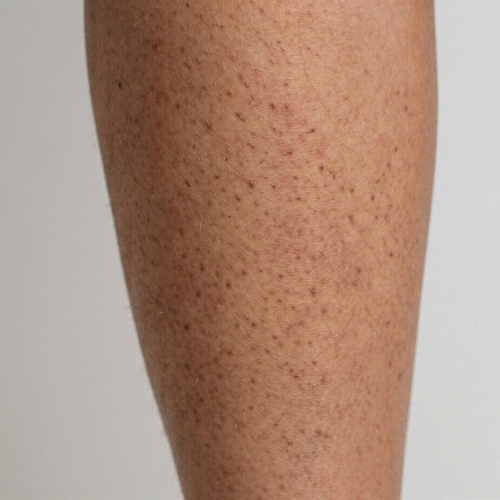 Närbild av keratosis pilaris – små sträva knottror på armarna