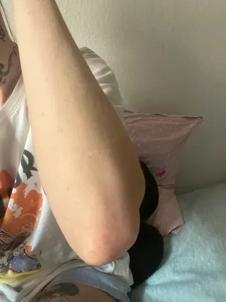 Kundresultat keratosis pilaris – Lisa A.