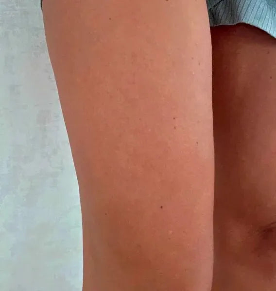 Kundresultat keratosis pilaris – Sarah S.