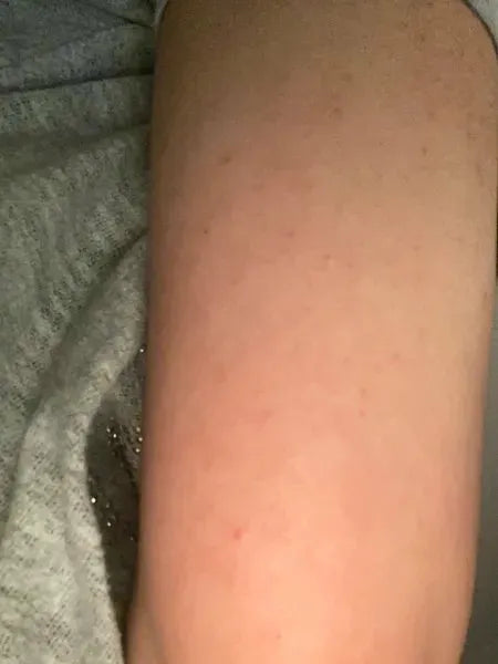Kundresultat keratosis pilaris – Shaian H. använder Australian Bodycare