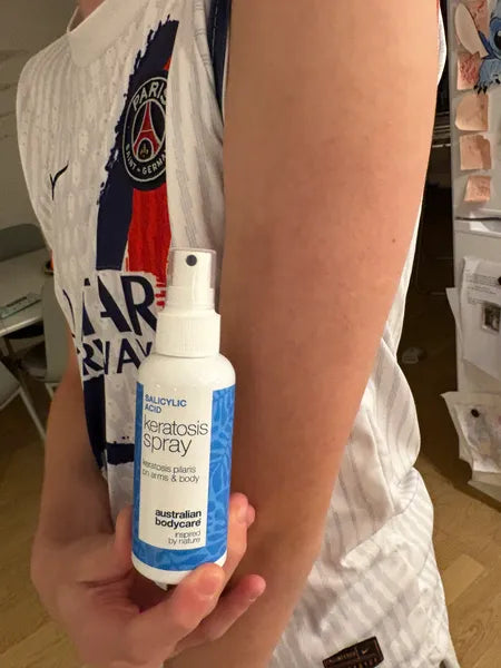 Kundresultat keratosis pilaris – 70% minskning av knottror efter 3 veckor